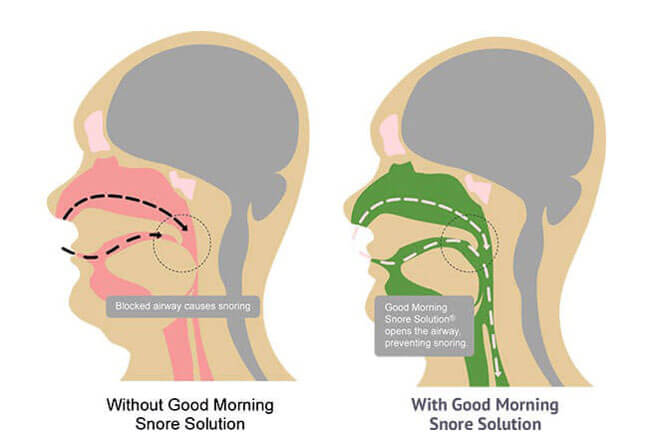 How Good Morning Snore Solution Works